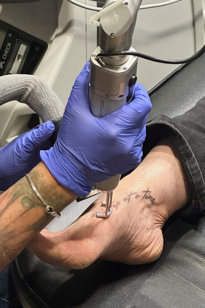 close up of a tattoo being removed from a person's foot